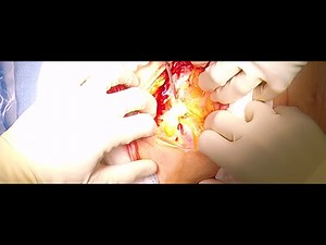 Cesarean Section; OBGYN Surgical Techniques with Dr. Kerry Campbell, MD