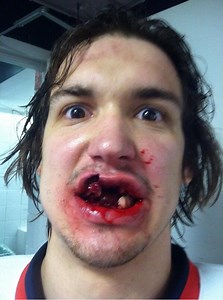 Grand Rapids Griffin snaps selfie after taking hockey puck to mouth