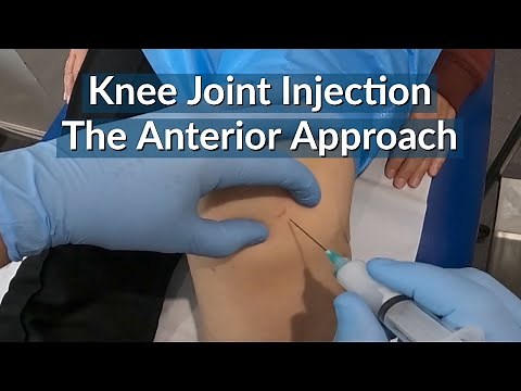 Knee Joint Injection : The Anterior Approach (eyes of the knee) - The most painless technique