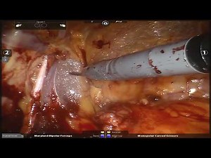 Robotic prostatectomy by Edward Schaeffer, MD, PhD