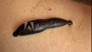 Medical leech on the human body drink blood. Treatment with leeches. Macro video.