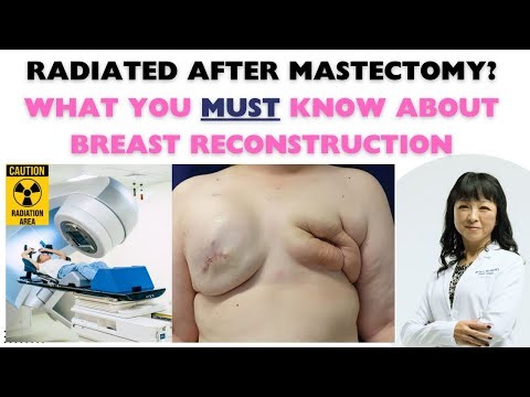 Top 3 secrets to breast reconstruction after radiation by board certified plastic surgeon