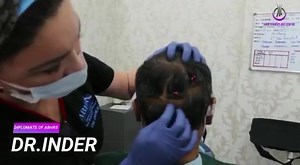 The two principal methods of Hair Transplant are Follicular Unit Transplant (FUT) and Follicular Unit Excision (FUE). In the FUT procedure, a strip of hair-bearing skin is removed from the donor area of the scalp usually the back of the head whereby in the FUE procedure there will be a series of tiny dot scars on the scalp but these are so small as to be scarcely noticeable. | Iplus Hair Regrowth Expert