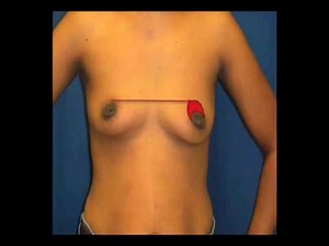 Breast Lift: The crescent lift mastopexy at CosmeticSurg