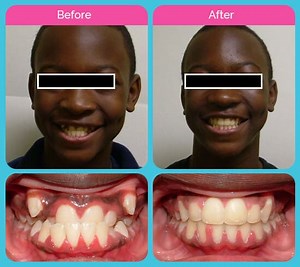 Invisalign Treatment Houston, Tx