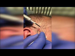 Seborrhoeic Keratosis Removal Demo