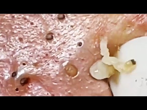 Blackheads Extraction part12