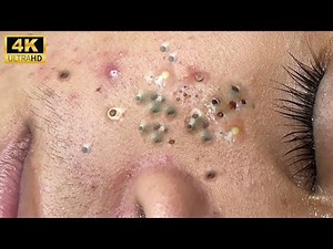 Relax every day with sec dep spa | blackheads removal and pimples popping ep 58