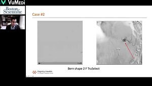 Truly Selective: Coil Embolization Case Studies