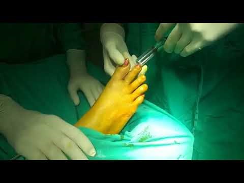Technique of toe ring block anesthesia injection.