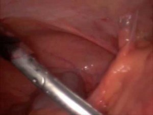 Ovarian Torsion with Dense Adhesions • Video • MEDtube.net