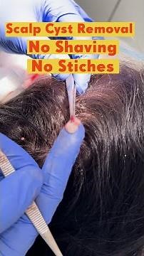 Scalp Cyst Removal: No Shaving, No Large Incisions, No Stitches, No Scars