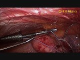 TLH with Bilateral Salpingo Ophorectomy • Video • MEDtube.net