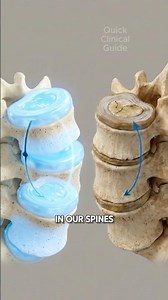 Degenerative Disc Disease Lumbar 3D #anatomy #lumbar #discdisease