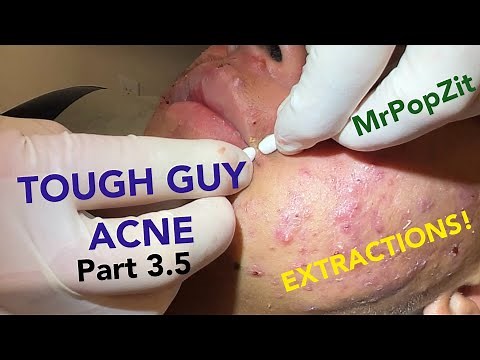 Tough guy acne part 3.5! Continue his extractions before he starts isotretinoin. Previous pops below