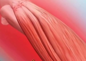 27 reactions | #Tennis_elbow or lateral epicondylitis is a condition...
