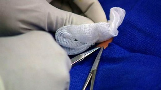 A doctor's guide to male circumcision