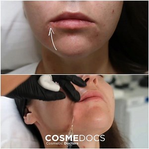 The CORNER LIP LIFT ☹️ ➡️ 🙂 On the LEFT is treated, RIGHT untreated. Just a few snippets today of Dr Burke lifting lip corners....not always as easy as you might think! Our #cornerlipflift is designed to lift a droopy/sad mouth. A common complaint where people can feel they look unhappy or angry all the time - EVEN AFTER lip filler. It’s not always related to age...even young people can have a downturned mouth for as long as they can remember 👶🏼 | Cosmedocs