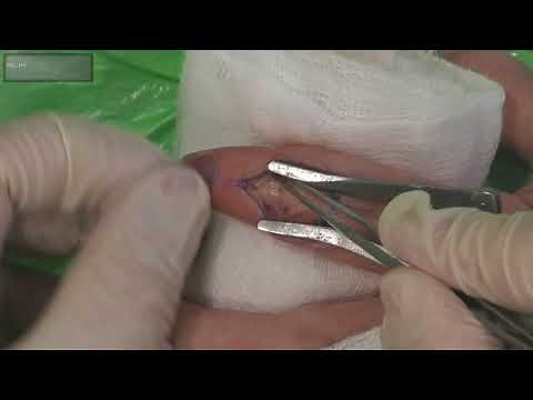 Middle Phalanx T Plate Fixation Distal Fracture