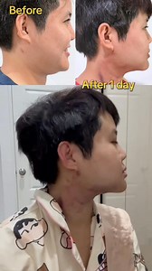 Jawline submental liposuction#faceliposuction #chinliposuction #doublechin #submentalliposuction | Natchaya Clinic