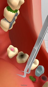 Stable and connect teeth machine repair in the treatment asmr #teeth #asmrvideo #asmr #shorts #care #shortsreels #reelsvideoシ #reelsviralシ #fbreelsfypシ゚viralfbreelsfypシ゚viral #reelsviralfb #facebookreelsviral #FacebookReelsContest #fbreelsfypシ゚ #fbreelsfypシ゚viral #reelsfypシ #teethcleaning #teethcare #care #reelstrending #reelsfacebook #reels2024 #reelschallenge #facebookviral #facebookreel #FacebookPage #trendingreelsvideo #trend #trendingreels #satisfying #satisfyingvideos Tunnig ASMR | Tunnig 