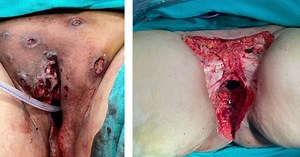 Laparoscopic total infralevatory pelvic exenteration and Singapore flap reconstruction for recurrent vulvar cancer