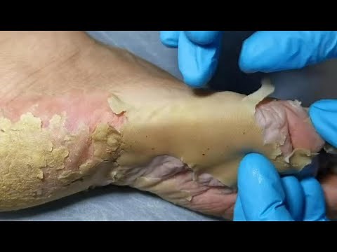 Podiatry : Skin peeling from feet. Dead skin removal & Cracked heels treatment. Dry skin treatment.