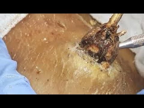 [ASMR] Lipoma on the neck blackheads! Dr. Pimple Popper clear remove follicular cysts 2511SS 143004