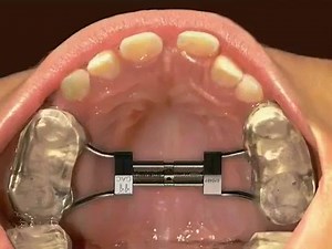 Palatal Expansion & teeth alignment with Braces! | Dr Moin Khan