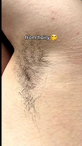 Permanent results WITHOUT expensive laser treatments Use Lumi 1x per week, and see visible results in just 3-4 uses. Each time you use it, you'll be left with smoother skin! The best part, you can use Lumi head to toe (not just your armpits!) Tell us, do you want permanently smooth skin?! 🎥 @tjinali | Rose Skin Co