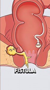 Why Perianal Abscess Can Create a Second Opening ⚠️..!!#e2dhealth #animation #2dshow #fypシ #health