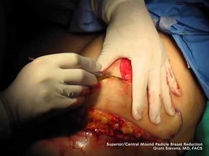 Superior Pedicle Technique of Reduction Mammaplasty: A Stepwise Approach