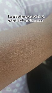 20 reactions · 5 comments | My skin about to be all types of f up body gonna hurt but I gotta get use to being outside in the sun 路‍♀️路‍♀️路‍♀️##fyp #bonnetchronicles #Aquarius #reelsvideos #lupus | Dominique Hardaway | Facebook