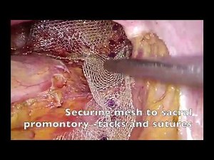 Laparoscopic ventral mesh rectopexy for rectal prolapse and obstructed defaecation