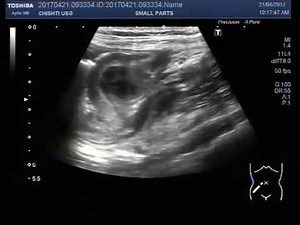 Ultrasound Video Appendicular mass with prominent lymph nodes.