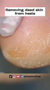 How to remove dead skin from heels in Minutes full treatment by miss foot fixer #deadskinremoval #heeltreatment #missfootfixer | Miss Foot Fixer | Facebook