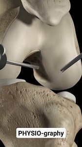 ACL reconstruction surgery using Hamstring graft #surgery #surgeon #grafting #ACL #aclrecovery #orthopedics #KneeSurgery #kneepain #injury Part 3 | PHYSIO-graphy