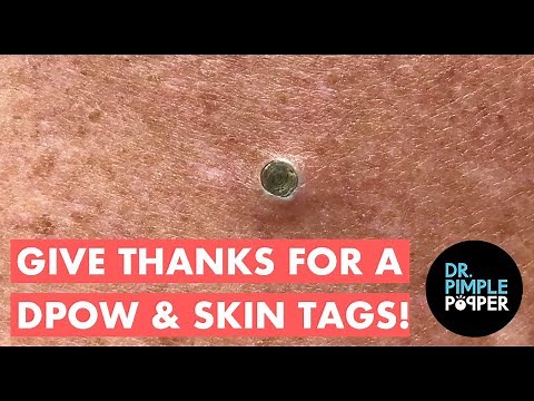 Give Thanks for a DPOW & Skin Tags!