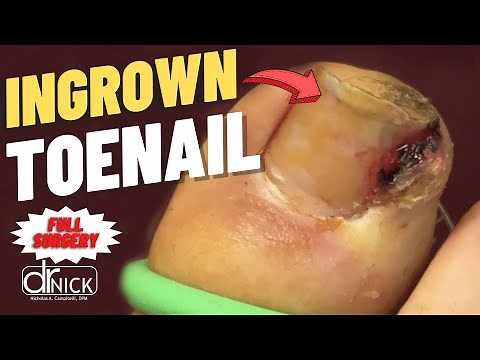 Extreme Closeup Ingrown Toenail Removal! | Dr. Nick Campitelli