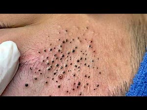 Blackhead Removal With Sac Dep Spa @113074874