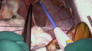 M - Resection of a large left atrial myxoma combined with mitral valve repair via a vertical right axillary thoracotomy in a