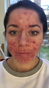 260K views · 572 reactions | Doctors said I have the worst acne they have ever seen #reels #viral #shakemybeauty #truly #acne #skin #badskin #anceskin #doctors | Born Different | Facebook
