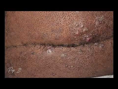 Satisfying Ingrown Hair Removal (Back of head) | Pt. 2