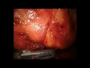 Retroperitoneal Robotic Partial Nephrectomy • Video • MEDtube.net