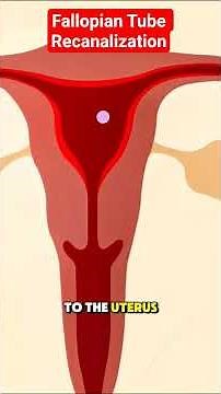 Fallopian Tube Recanalization
