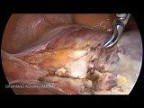 Total Laparoscopic Hysterectomy ESGE Guideline  • Video • MEDtube.net