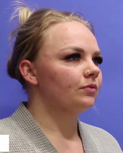 Reno NV Neck Liposuction with FaceTite | Neck Lipo Before & After | Avance Plastic Surgery Institute