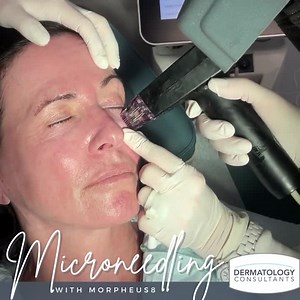 Morpheus 8 is an excellent treatment option to improve under-eye bags...