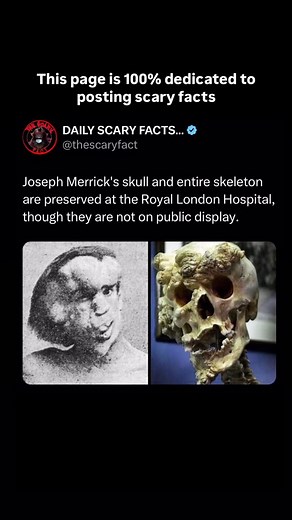 Joseph Merrick, known as the Elephant Man, suffered from severe physical deformities and gained notoriety in the late 19th century. After his death in 1890, his skeleton was preserved for medical study and remains housed at the Royal London Hospital. While his full skeleton, including his skull, is kept for research purposes, it is not accessible to the public. Merrick’s soft tissue was reportedly buried in an unmarked grave, though its exact location remains uncertain. | thescaryfact