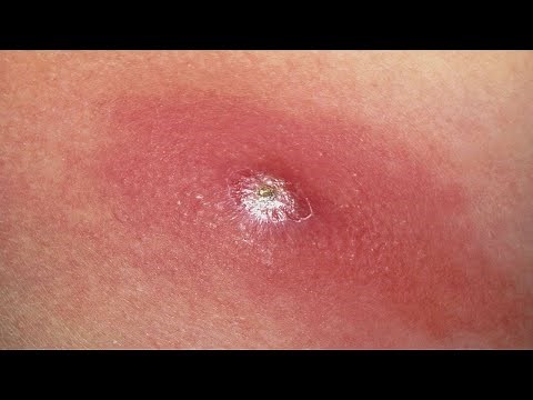 how to get rid of ingrown hair cysts extremely easy
